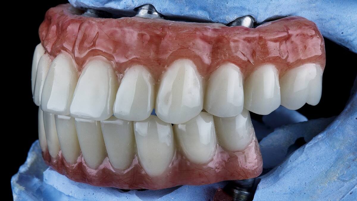 5 Common Regrets After All-on-4 Implants
