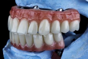5 Common Regrets After All-on-4 Implants