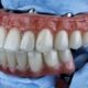 5 Common Regrets After All-on-4 Implants