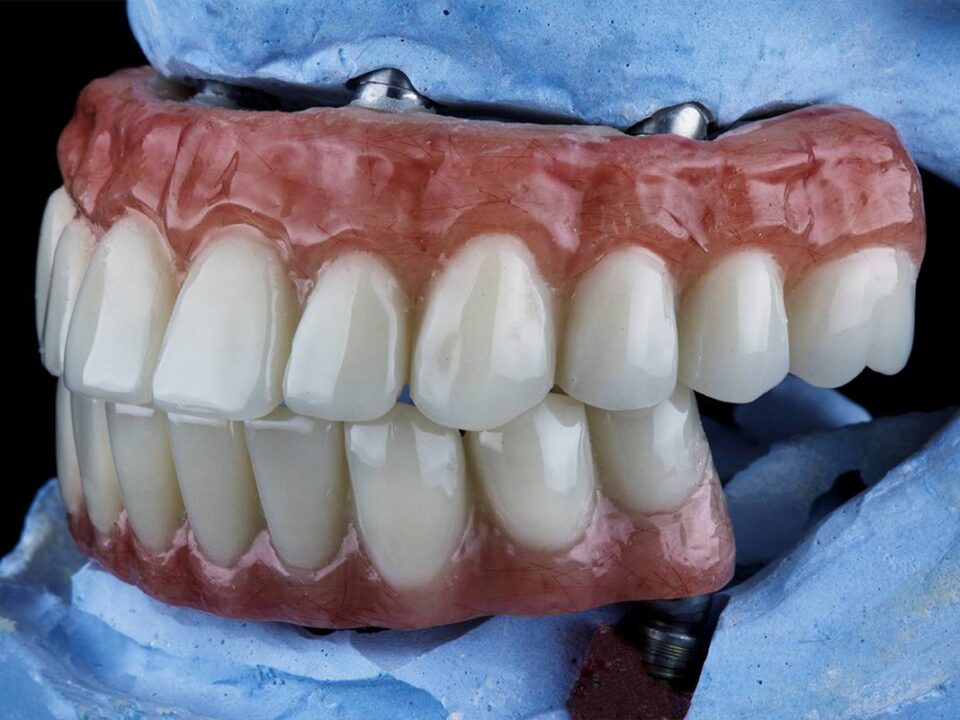 5 Common Regrets After All-on-4 Implants