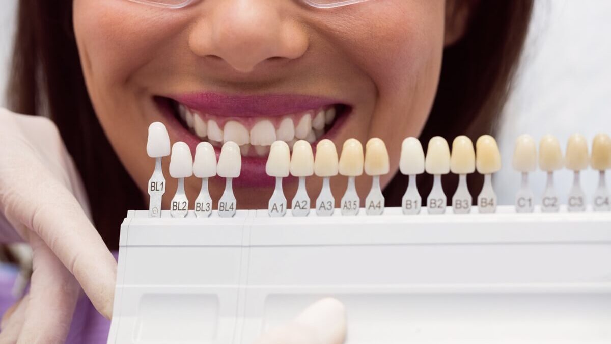 8 Benefits of Dental Veneers