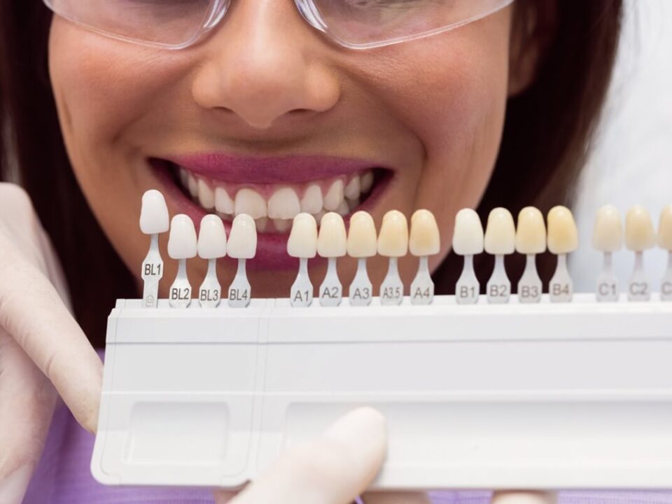 8 Benefits of Dental Veneers