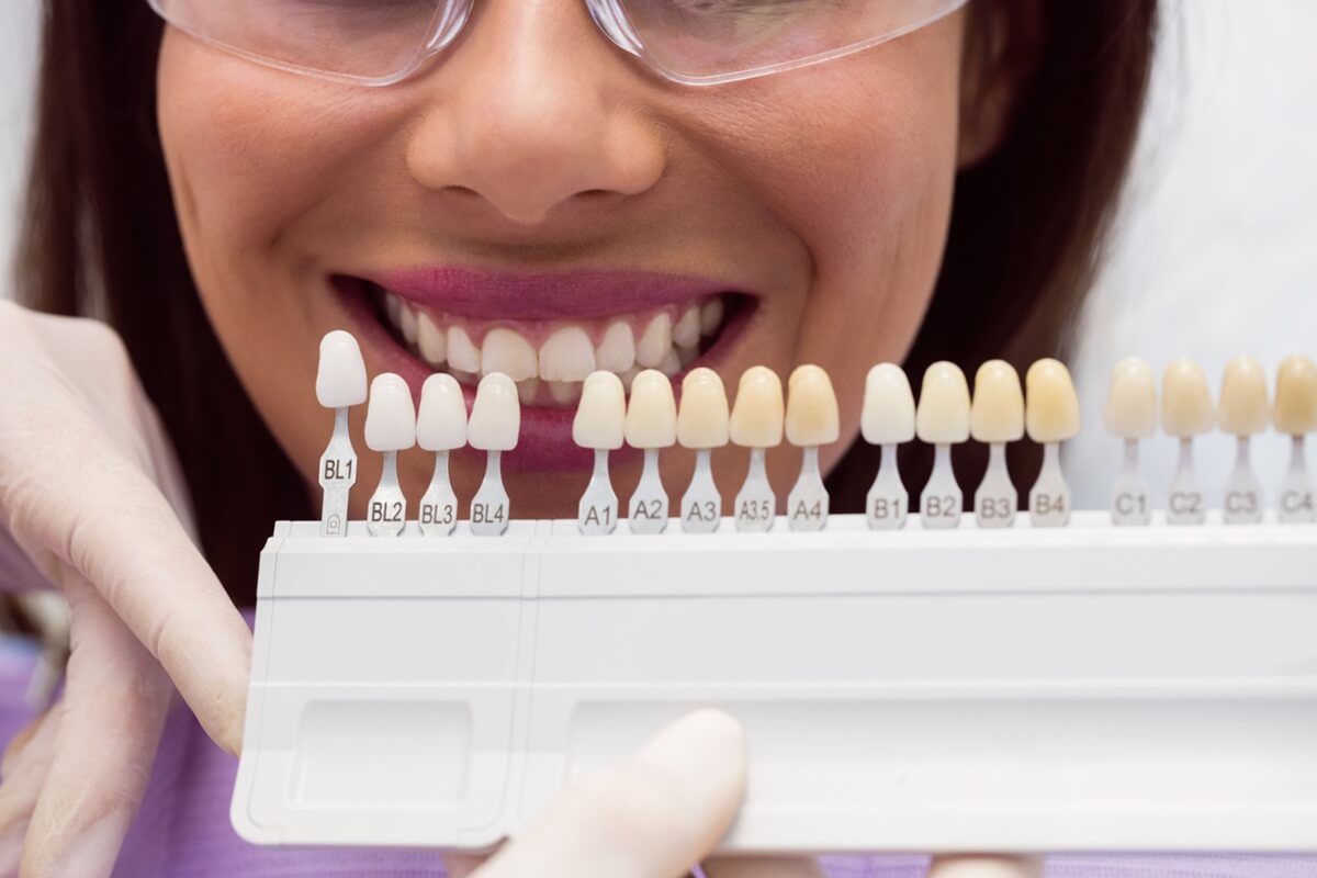 8 Benefits of Dental Veneers