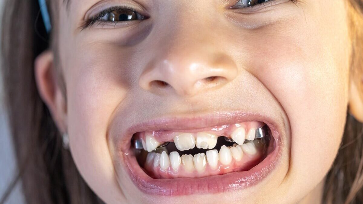 8 Common Causes of Crooked Teeth