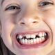 8 Common Causes of Crooked Teeth