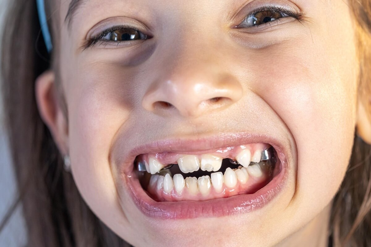 8 Common Causes of Crooked Teeth