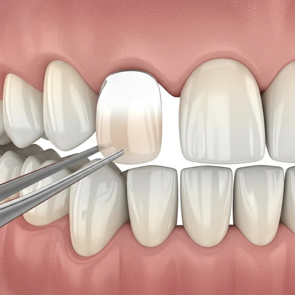 Additional Procedures Affecting Veneer Pricing