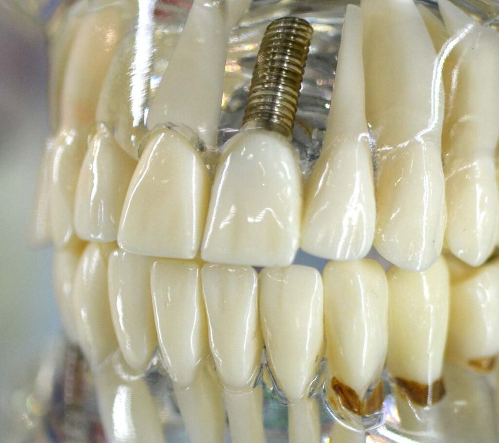 Affordable Dental Implants Woodinville, WA