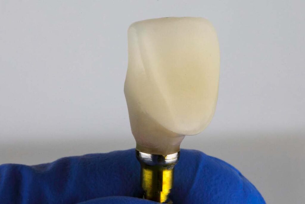 Affordable Dental Implants in Woodinville, WA