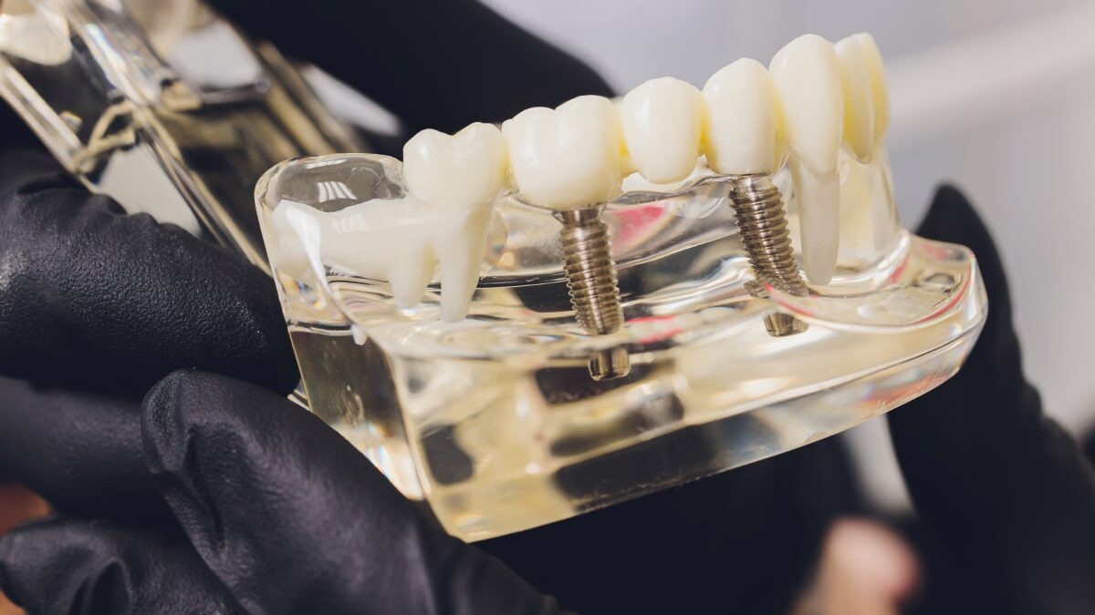 All-on-4 Dental Implants Cost in Washington