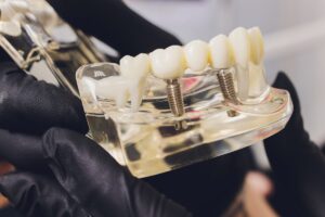 All-on-4 Dental Implants Cost in Washington