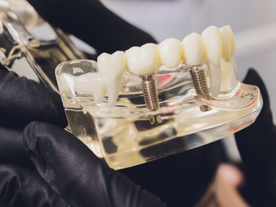 All-on-4 Dental Implants Cost in Washington