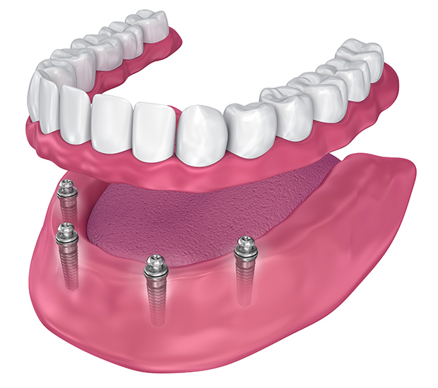 All-on 4 Dental Implants