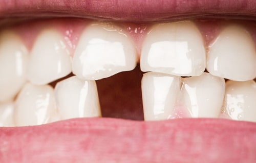 Am I a Good Candidate for Dental Implants