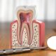 Apicoectomy vs Root Canal