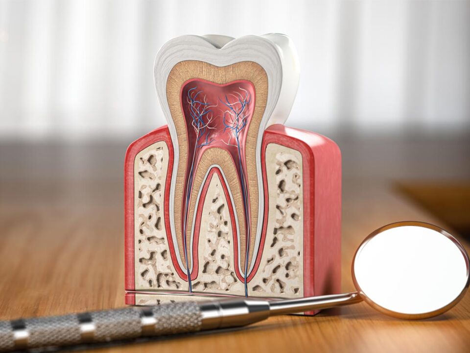 Apicoectomy vs Root Canal