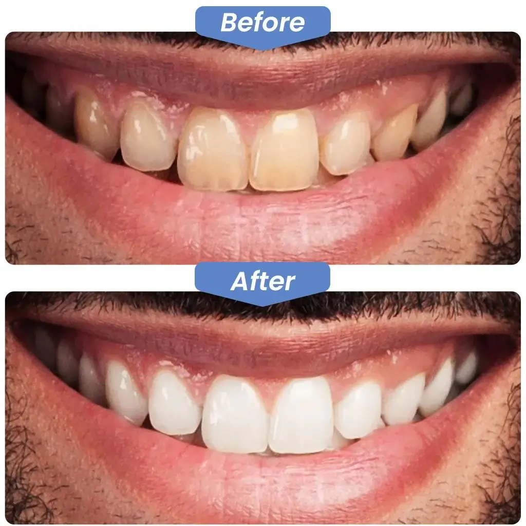 Before After Dentistry, Dentist, Dental, Kirkland Dental Excellence