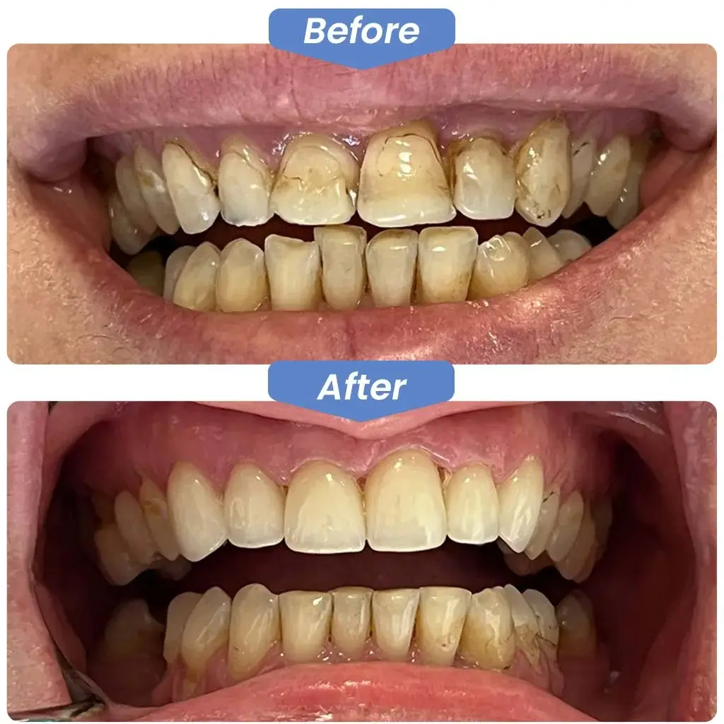 Before After Dentistry, Dentist, Dental, Kirkland Dental Excellence