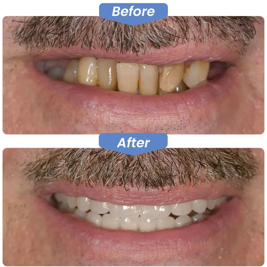 Before After Dentistry, Dentist, Dental, Kirkland Dental Excellence