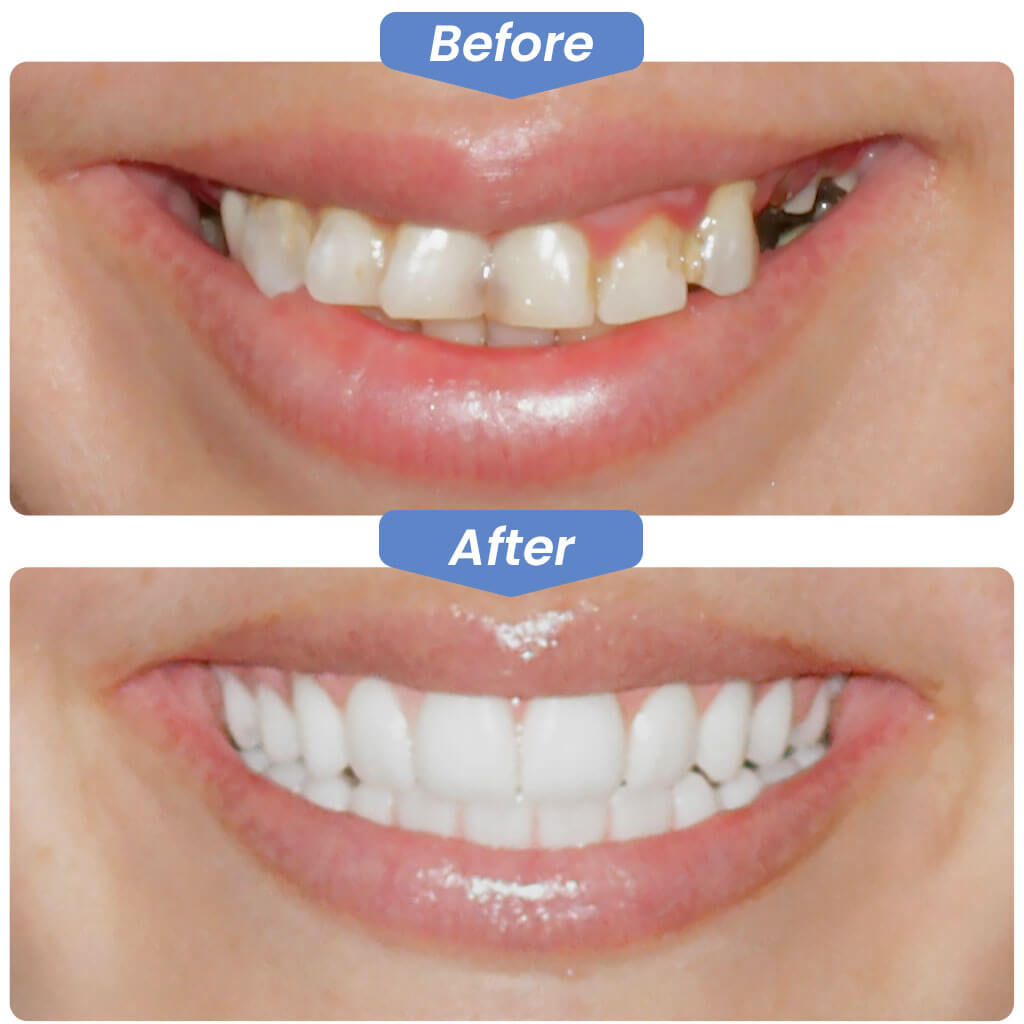 Before After Smile Gallery - Best Dentistry in North Rose Hill