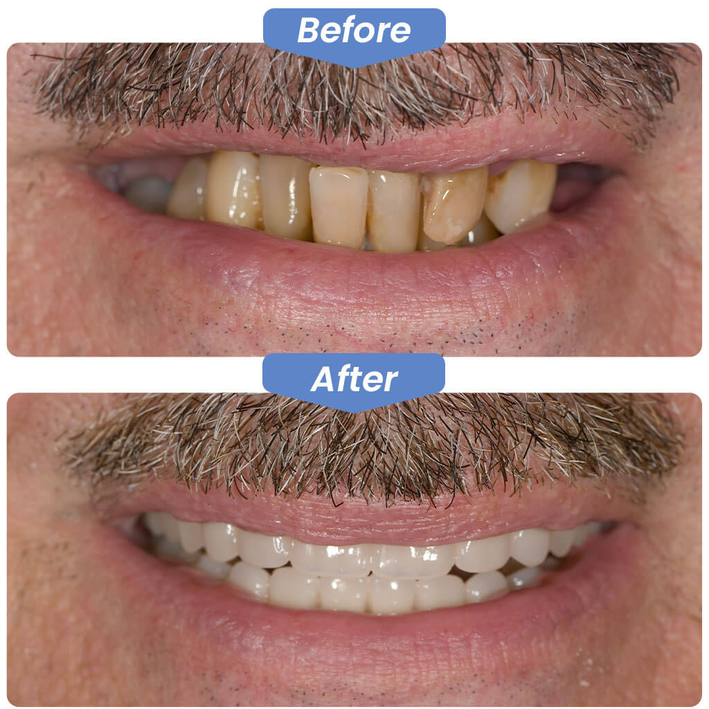 Before After Smile Gallery - Best Dentistry in Redmond