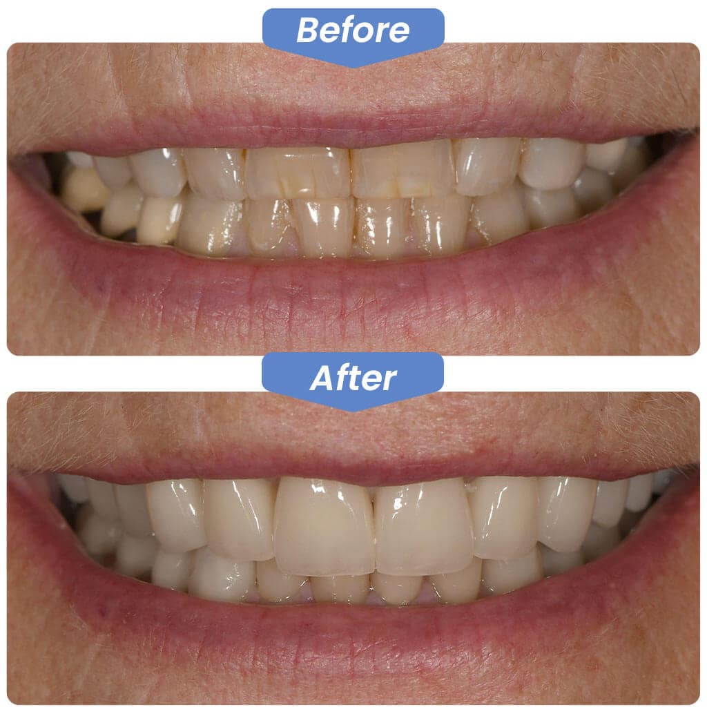 Before After Smile Gallery - Best Dentistry in Redmond