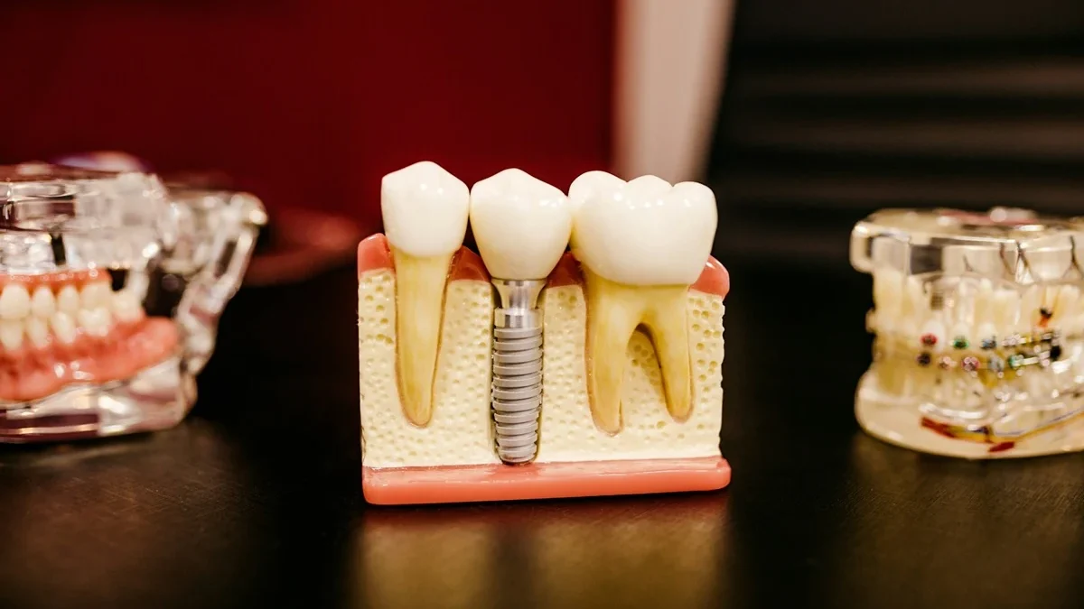 Before and After Dental Implants in Kirkland: Real Results