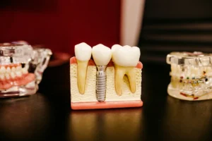 Before and After Dental Implants in Kirkland: Real Results