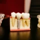 Before and After Dental Implants in Kirkland: Real Results