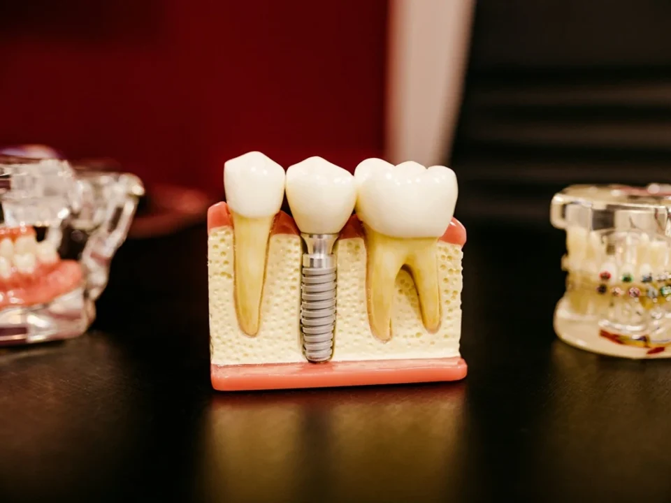 Before and After Dental Implants in Kirkland: Real Results