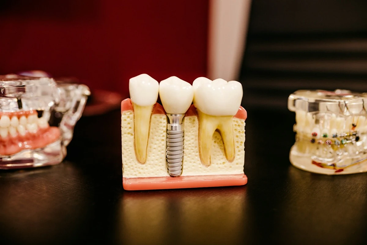 Before and After Dental Implants in Kirkland: Real Results