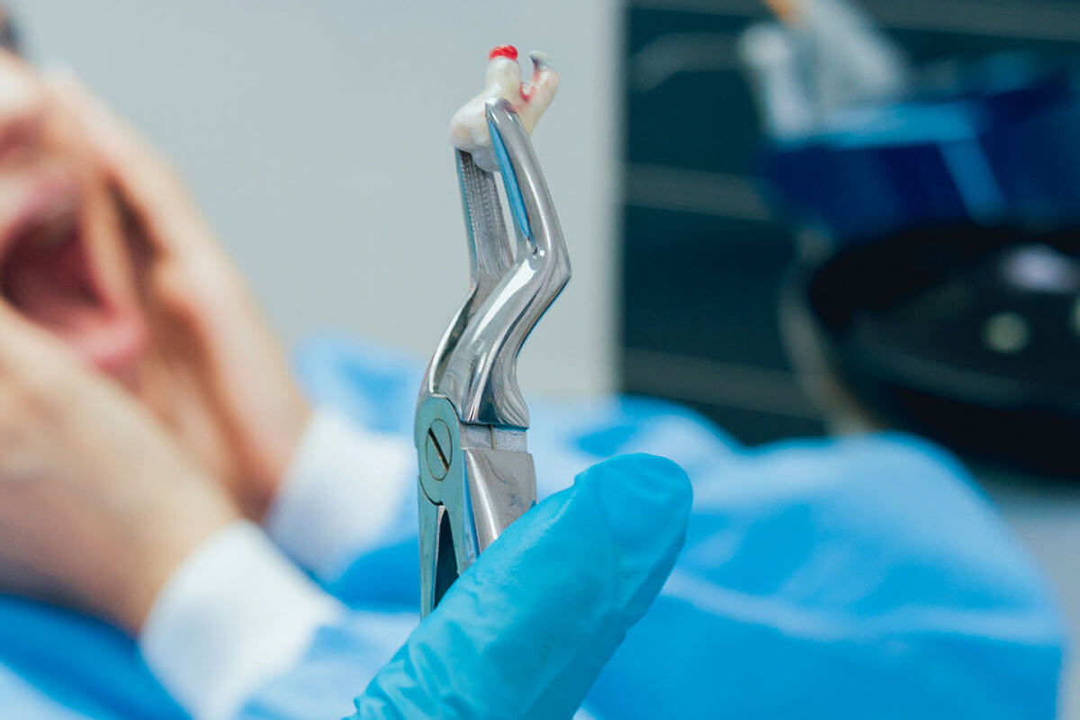 Beginner's Guide to Tooth Removal