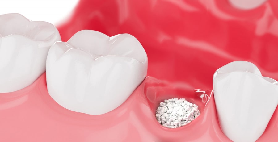 Bone Grafting for Implant Stability