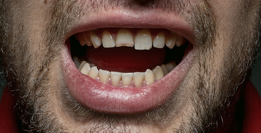 Broken or Chipped Tooth