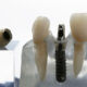 Can Dental Implants Be Removed?