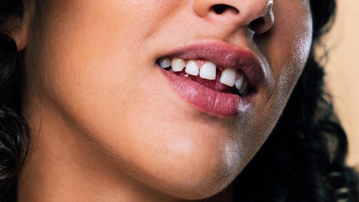 Can Teeth Gaps Be Closed With a Composite Filling?