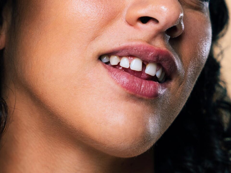 Can Teeth Gaps Be Closed With a Composite Filling?