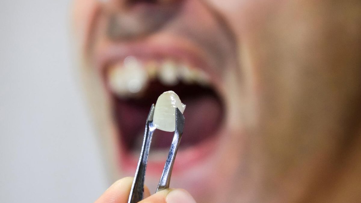 Can a Dental Crown Be Removed?