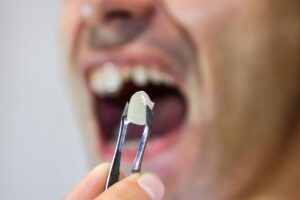 Can a Dental Crown Be Removed?