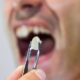 Can a Dental Crown Be Removed?