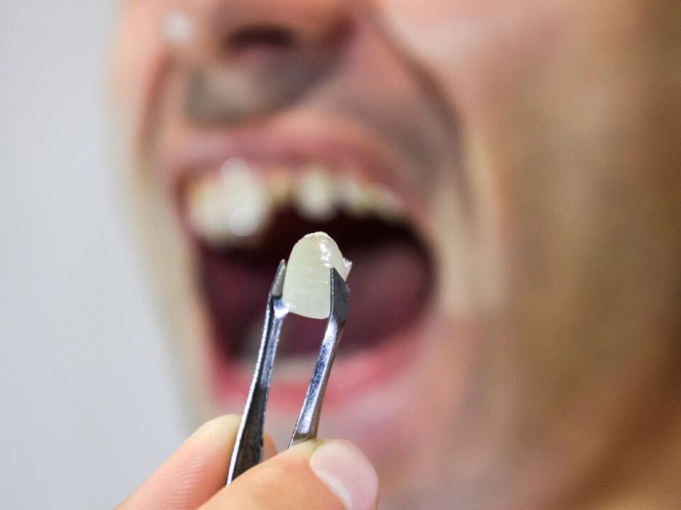 Can a Dental Crown Be Removed?
