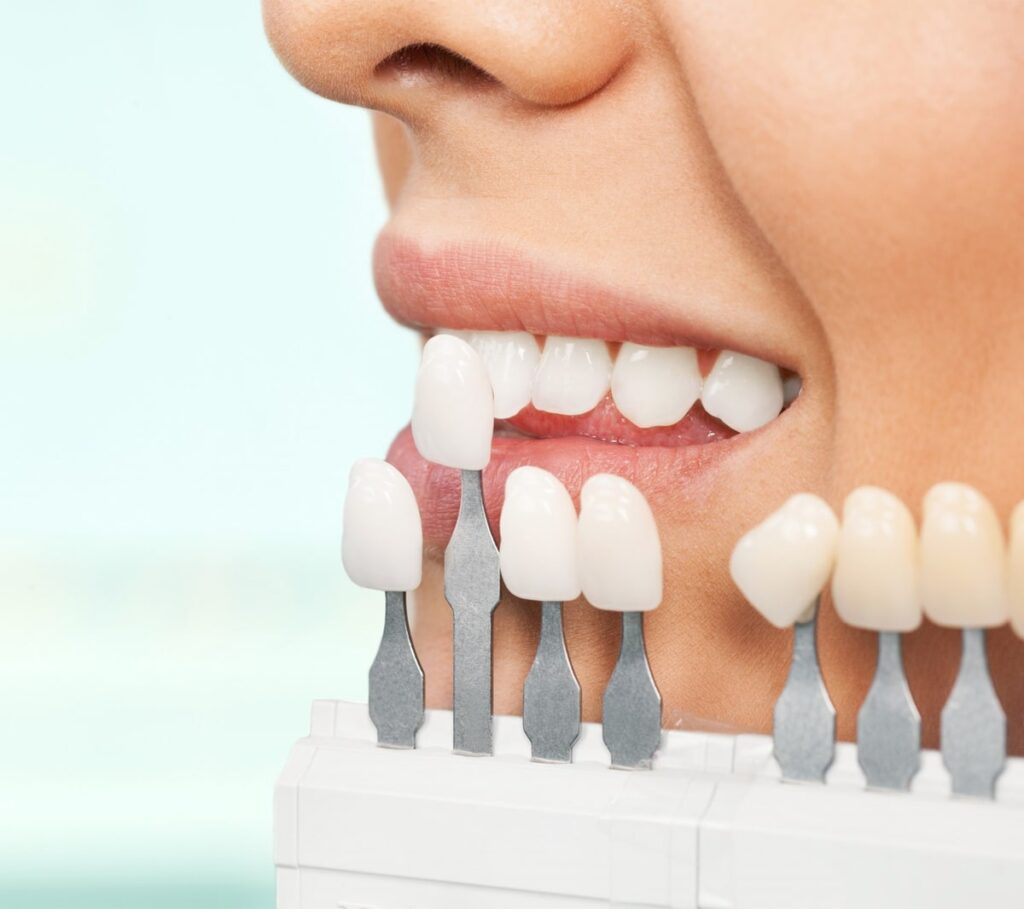 Composite Veneers Kirkland