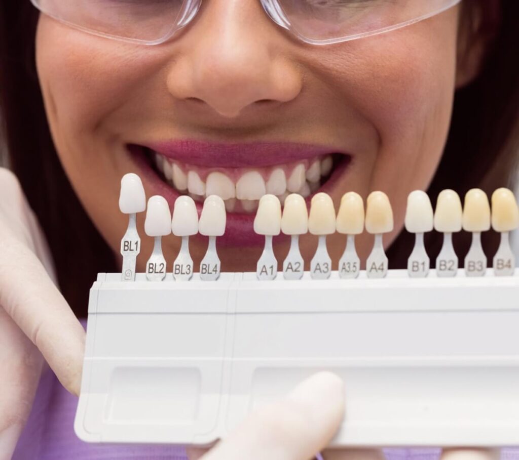 Composite Veneers Kirkland