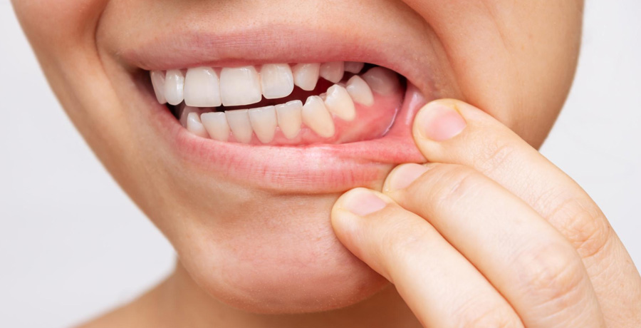 Dental Abscess