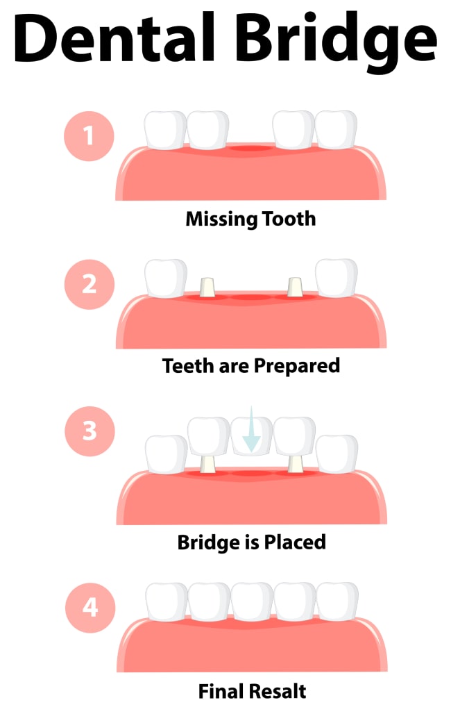 Dental Bridge Procedure