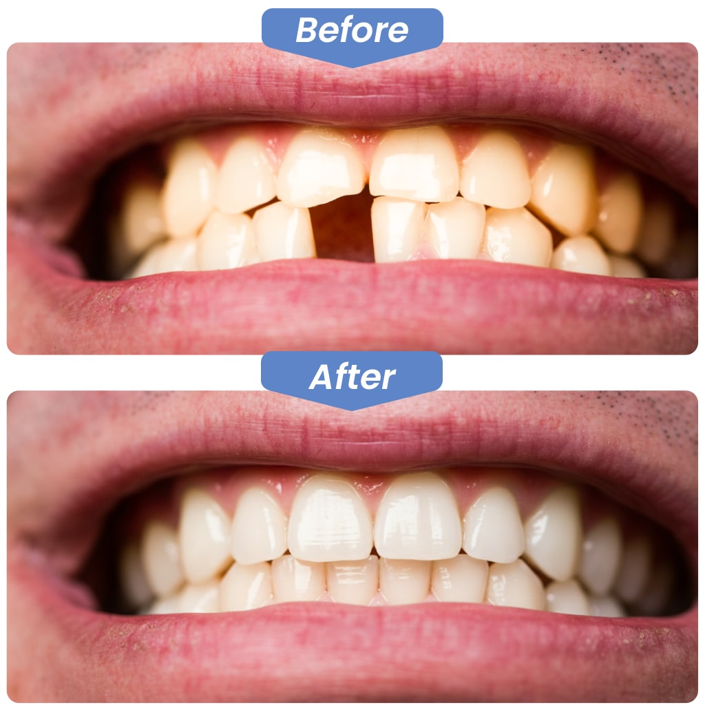 Dental Bridges before after in Kirkland
