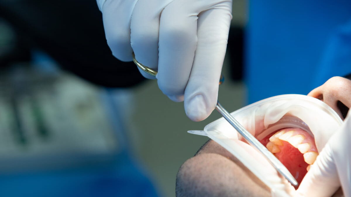 Does a Dental Crown Need a Root Canal