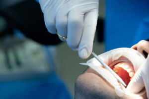 Does a Dental Crown Need a Root Canal