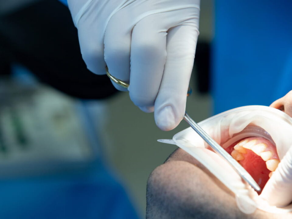 Does a Dental Crown Need a Root Canal