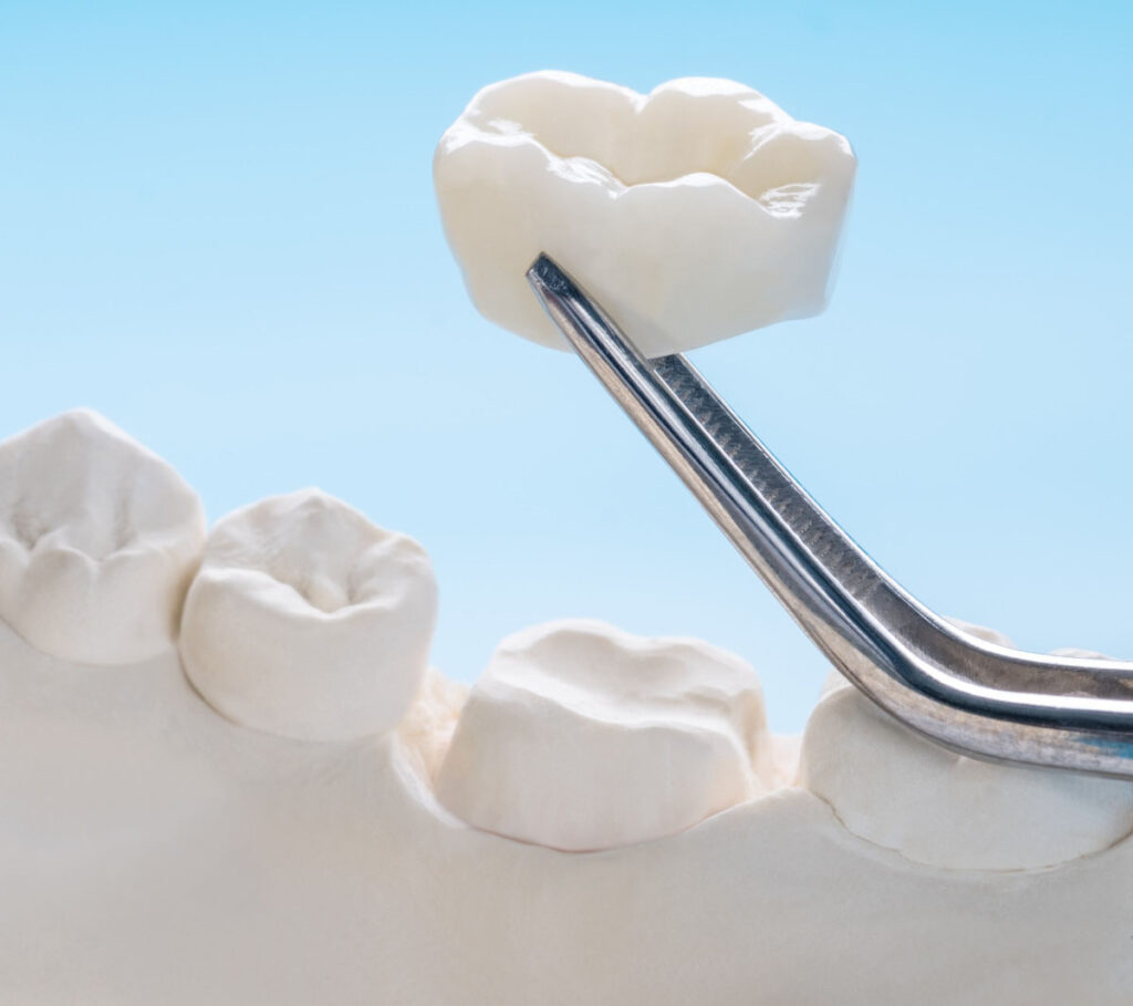 Dental Crowns in Seattle, WA